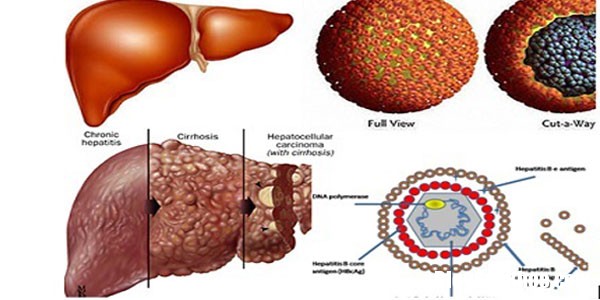 viem gan b bien chung nguy hiem xo gan Cần chế độ chăm sóc gan cho người mắc bệnh mạn tính