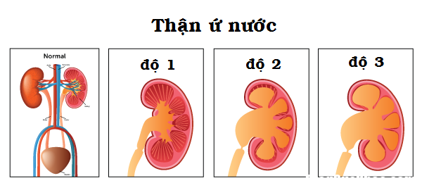 1.1 Cách nhận biết bệnh thận ứ nước