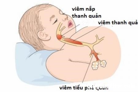 3tyyxyw2222223zvzrrnviemtieuphequan bjqy Đề phòng bệnh viêm tiểu phế quản ở trẻ khi trời trở lạnh