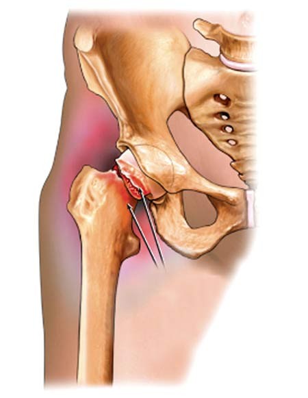 44 Các dấu hiệu nhận biết bệnh thoái hóa khớp háng