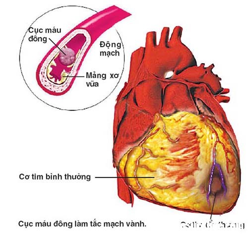 dot quy 1415541828821 Phòng ngừa đột quỵ não khi thời tiết giao mùa