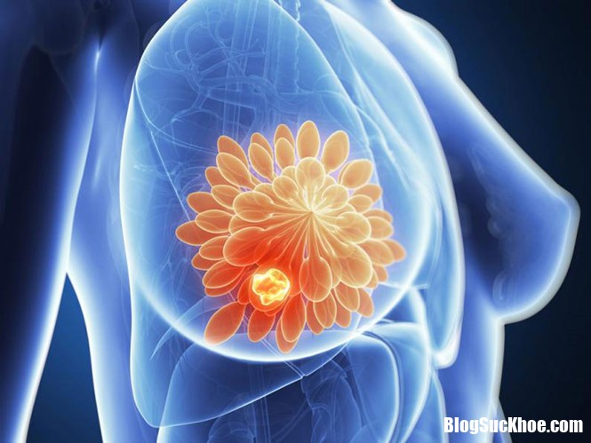 nguc nirr Phụ nữ có mô ngực dày có nguy cơ ung thư vú cao