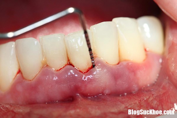 rang sau khi boc su bi nhuc 1 Cách khắc phục chứng đau sau bọc răng sứ