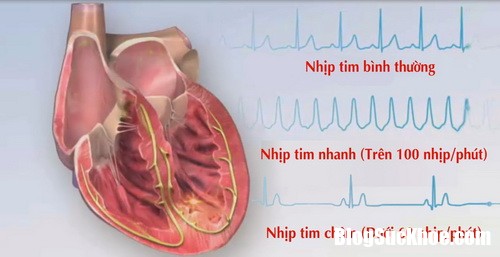 roi loan nhip tim khi dung thuoc chua liet da day resize Dùng thuốc chữa liệt dạ dày có nguy cơ bị bệnh tim mạch