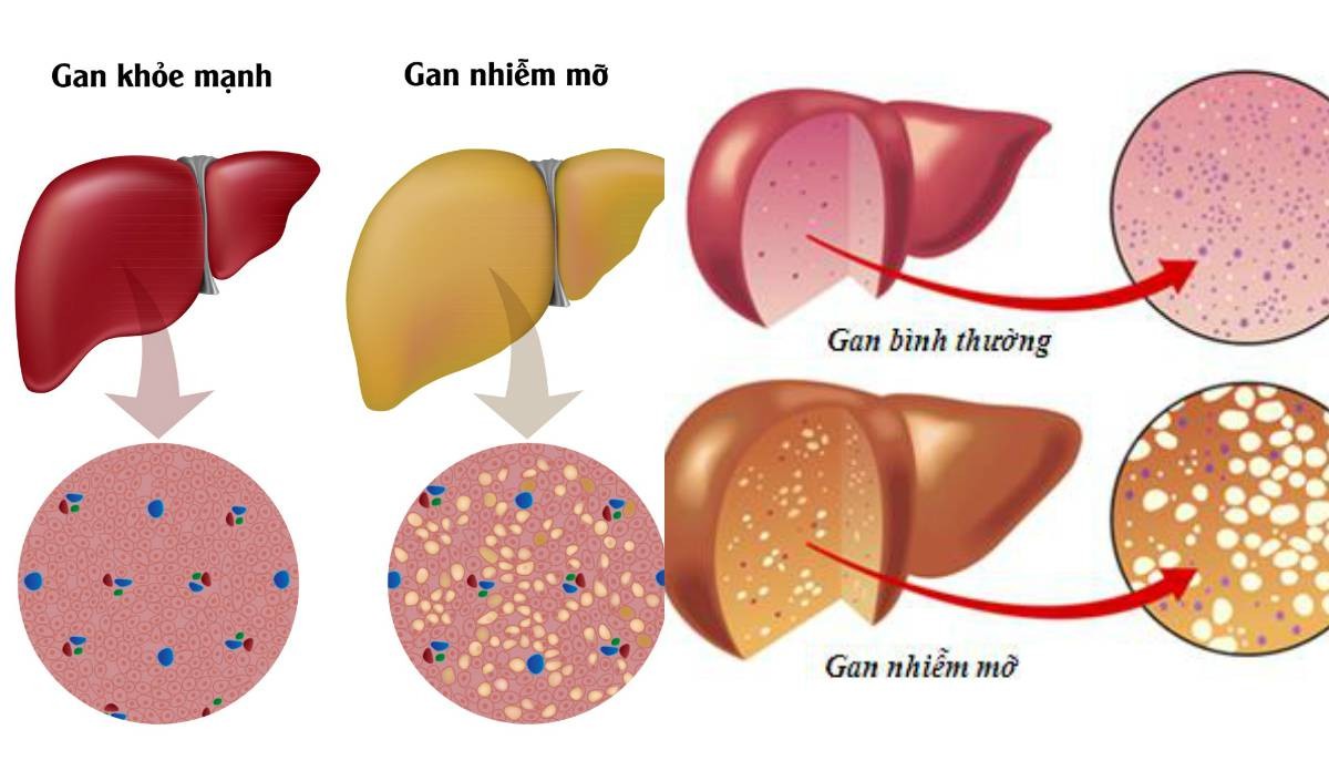 sieu am gan 1 Những yếu tố nguy cơ gây bệnh gan nhiễm mỡ