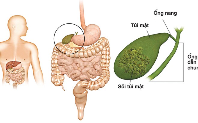 soimatdodaumaco 1508126411579 0 140 1020 1782 crop 1508126417545 Những triệu chứng bất thường cảnh báo túi mật có vấn đề