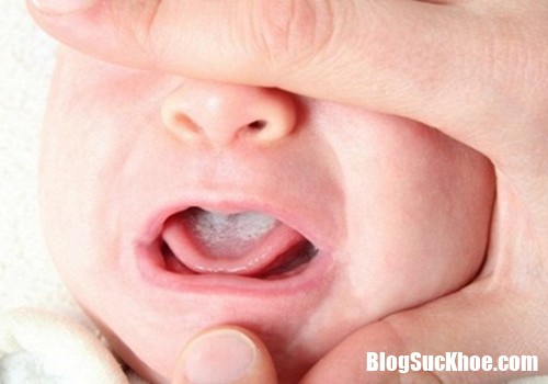 tre bi nhiet mieng va sot 1 Nguyên nhân gây bệnh nấm lưỡi ở trẻ