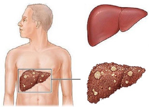 2 6845 1504066230 Phương pháp mới điều trị ung thư gan tiên tiến