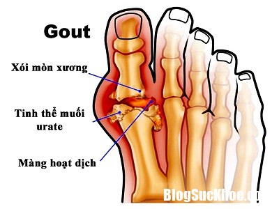 benh gut 2 Dùng thuốc điều trị gút đúng cách mới đạt hiệu quả cao