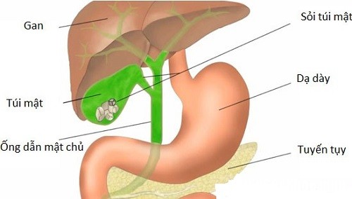 soi mat 1556 1502943338 Cách chữa sỏi mật đơn giản không cần phẫu thuật