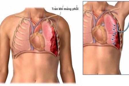tran khi mang phoi 11953390 Tràn khí màng phổi thực sự rất nguy hiểm và có thể gây tử vong