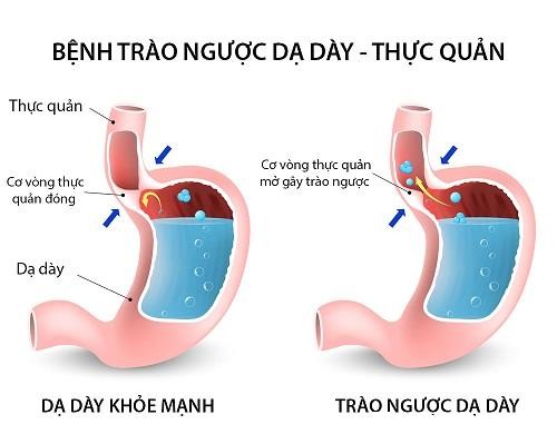 trao nguoc da day la gi 1 171049994 Nguy cơ ung thư thực quản do trào ngược dạ dày