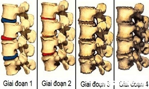 Giai doan thoai hoa 5044 1513054608 Dấu hiệu nhận biết thoái hóa cột sống