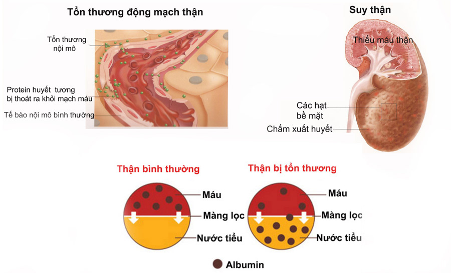 PR1.1 2 Dấu hiệu cho thấy thận đang gặp vấn đề cần phải thanh lọc