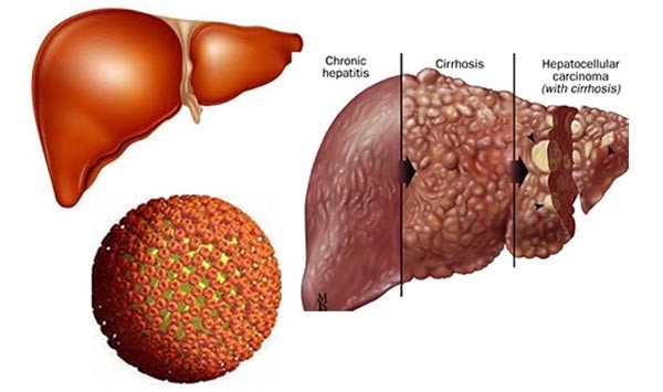 benh viem gan B Những điều chưa biết về bệnh viêm gan B