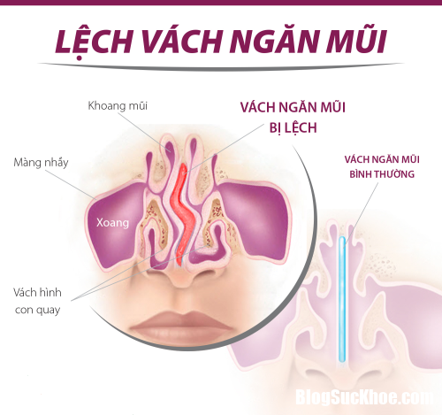 lech vach ngan mui 23152599 Có nên phẫu thuật khi bị lệch vách ngăn mũi ?