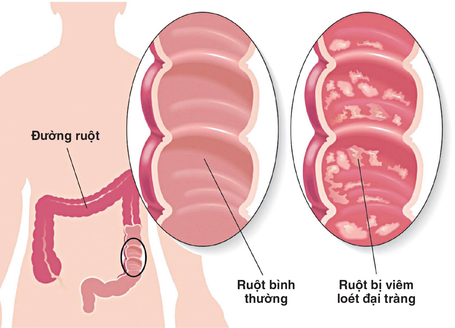 nhan biet viem loet Viêm loét đại trực tràng chảy máu và dấu hiệu nhận biết