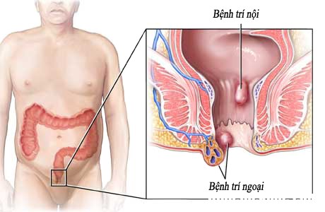 20150319 nhung hieu biet ve benh tri anh 1 Nguyên nhân và cách phòng ngừa bệnh trĩ