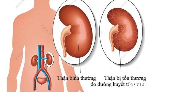 3 57828 Người bị mắc bệnh về thận có nguy cơ cao bị bệnh đái tháo đường