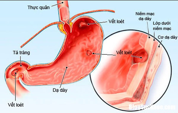 benh ve duong tieu hoa2 Những loại bệnh thường gặp ở đường tiêu hóa