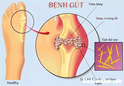 benh gut Nguyên nhân và cách điều trị bệnh gout