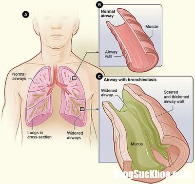 bronchiectasis Người nào dễ bị giãn phế quản?