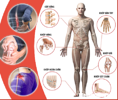 cac khop de bi ton thuong Bệnh cơ xương khớp chính là nguyên nhân chính gây tàn phế