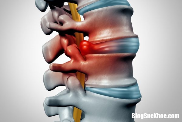 dia dem thoat vi chen ep day than kinh 600x401 Dấu hiệu thường thấy giúp nhận biết bệnh thoát vị đĩa đệm