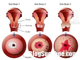 index 6 Những dấu hiệu và triệu chứng sớm của ung thư cổ tử cung