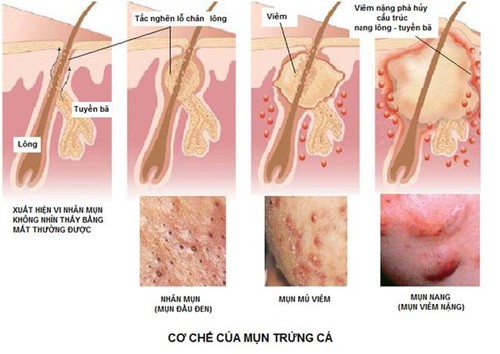 lam gi khi mun trung ca co dau hieu nhiem trung 1 Mụn trứng cá có dấu hiệu nhiễm trùng phải làm sao ?