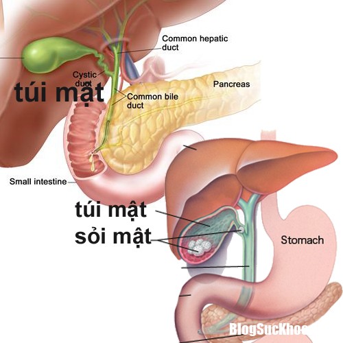 soi mat a32fd Người bị sỏi mật có nguy cơ bị bệnh tim