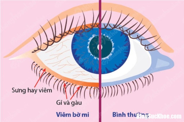 tim hieu cach chua benh viem bo mi mat va nguyen nhan hinh anh 2 Làm việc với máy tính quá nhiều khiến bệnh viêm bờ mi tăng cao