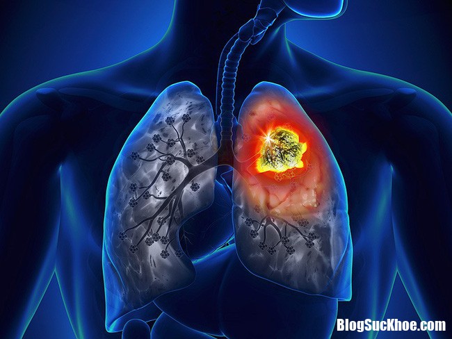 ung thu phoi 1515008423352 Lưu ý ngay 10 dấu hiệu cảnh báo sớm bệnh ung thư phổi