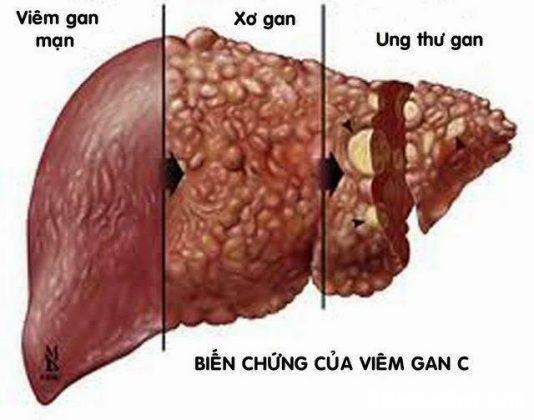 viem gan c 1 534x420 Viêm gan C nguy hiểm đến mức nào ?