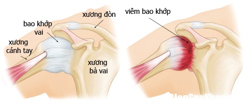 viem quanh khop vai1 Chớ nên xem nhẹ chứng viêm quanh khớp vai