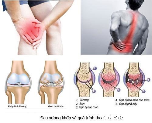 1 40171 Nguyên nhân và triệu chứng của bệnh xương khớp