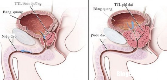 chung tieu dem o nguoi cao tuoi 1.png Nguyên nhân và cách phòng trị bệnh tiểu đêm ở người già