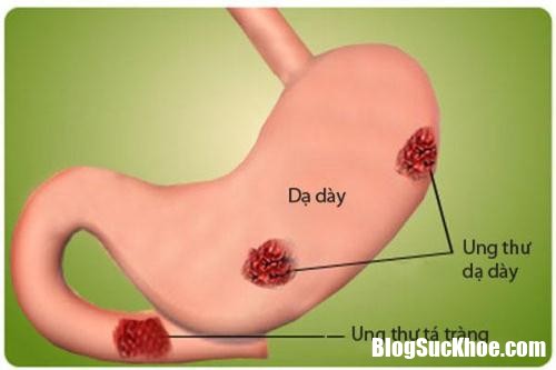 co the nhan biet ung thu da day tu nhung dau hieu sau 2 12153528 1 Những dấu hiệu giúp nhận biết ung thư dạ dày