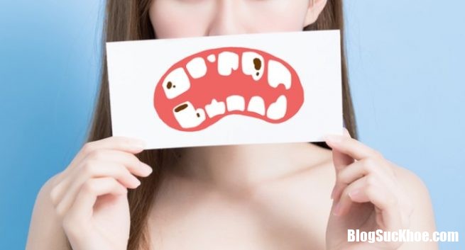 dental cavities 655x353 Tăng nguy cơ tử vong do sức khỏe răng miệng kém