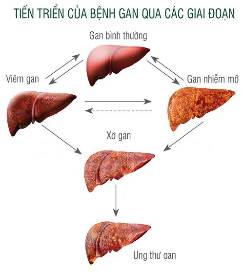 gan11 Vì sao bệnh gan nhiễm mỡ có thể chuyển biến thành xơ gan ?