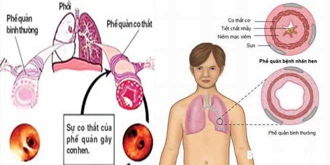 1509328908 khac phuc sai lam khi dung thuoc tri hen Những sai lầm khi dùng thuốc trị hen cần tránh ngay