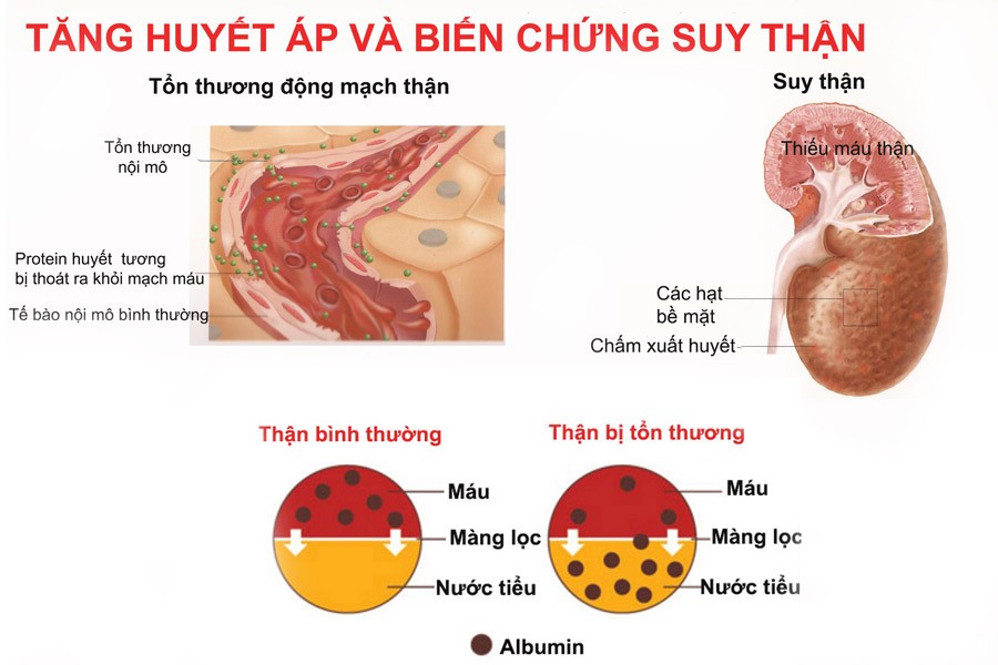 1510024056 tang huyet ap va bien chung kho luong 1 Những biến chứng khó lường do tăng huyết áp gây ra