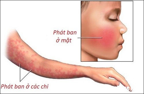 9 Mùa xuân hè nhớ phòng bệnh ban đỏ nhiễm khuẩn