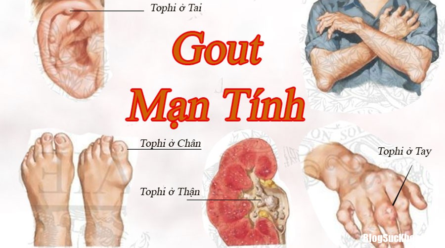 Benh gut Những biến chứng của bệnh gút và thuốc điều trị