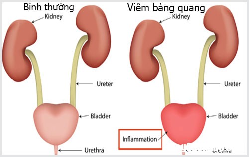 Viêm bàng quang là bệnh gì 1 Cách phòng ngừa viêm bàng quang cấp ở phụ nữ