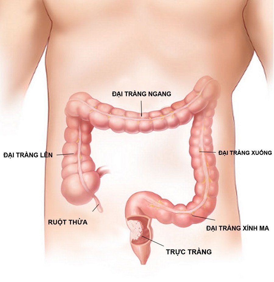 benh dai trang cap va man tinh Viêm đại tràng dễ có nguy cơ thành bệnh mạn tính