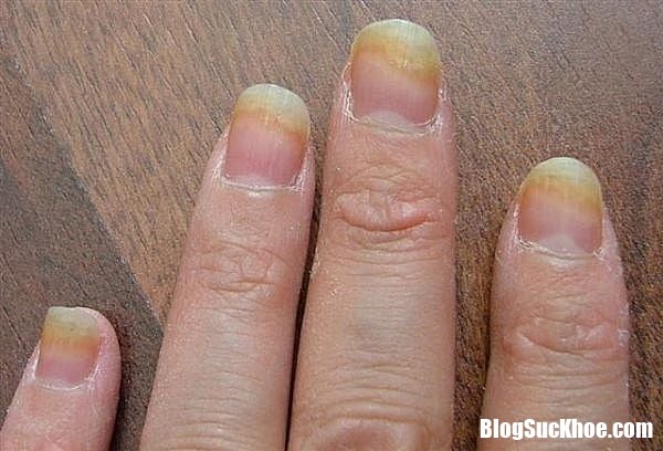 benh nam mong tay co lay khong 600x408 Cách trị và phòng ngừa bệnh nấm móng tay