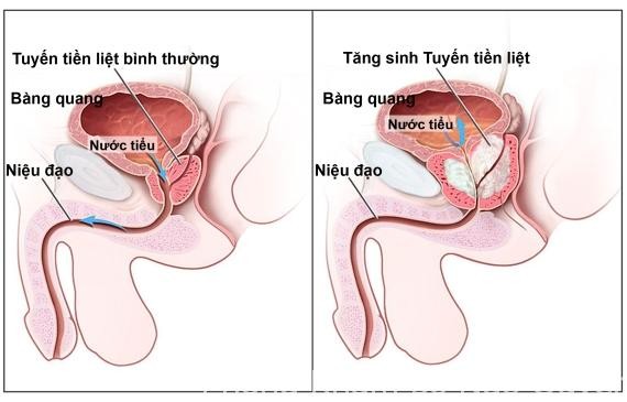 benh u xo tuyen tien liet Những yếu tố chính gây nên u xơ tuyến tiền liệt