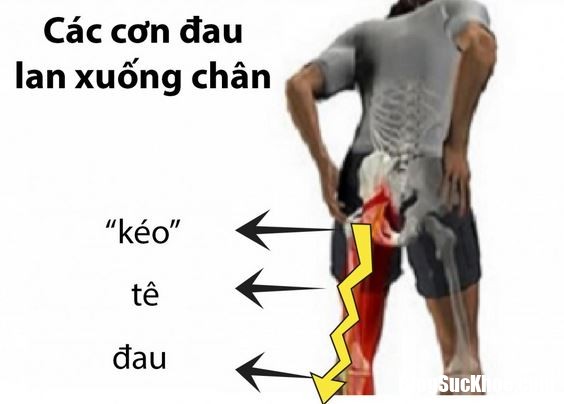 cac dau hieu dau day than kinh toa can canh giac 2 Cần cảnh giác với những dấu hiệu bệnh đau dây thần kinh tọa