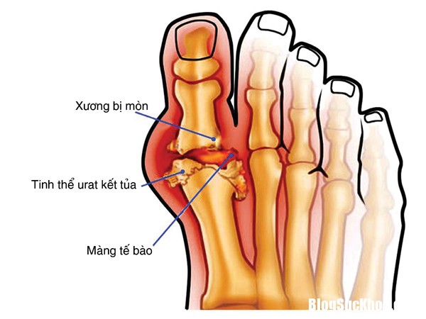 canh giac con gut Cách kiểm soát cơn gút